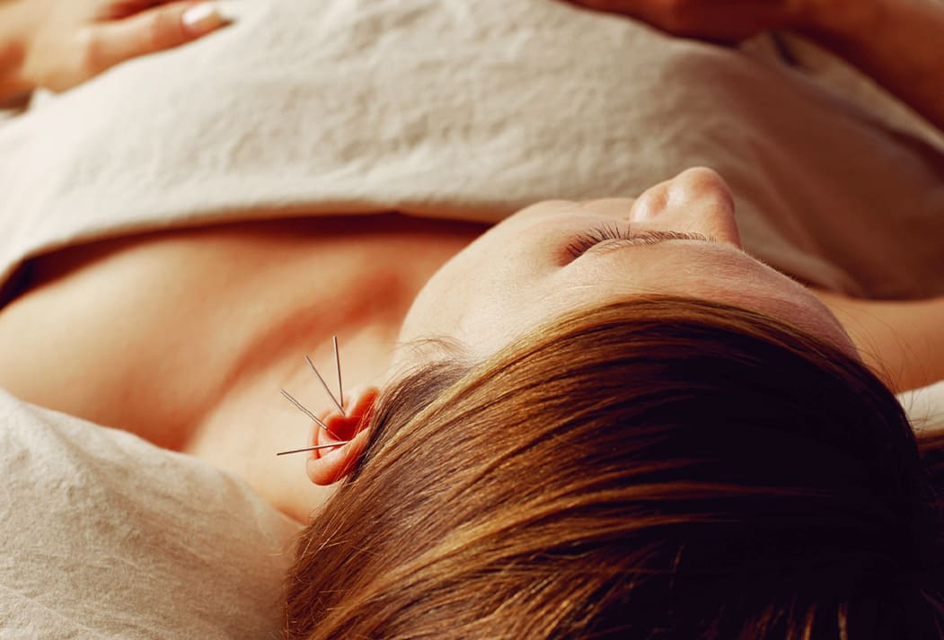 Acupuntura